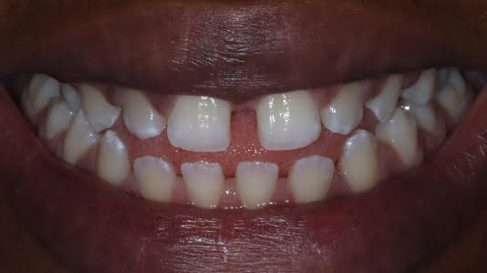 before invisalign whitening and bonding