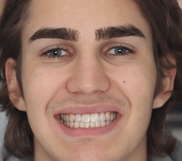 before invisalign whitening and bonding
