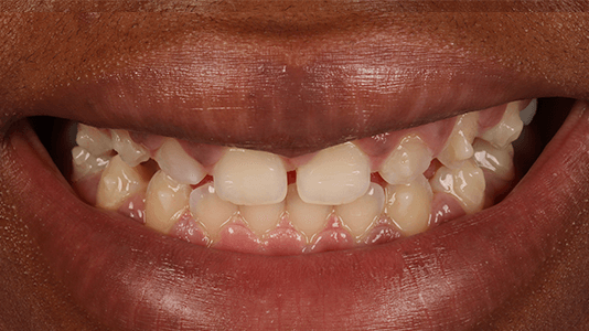before invisalign whitening and bonding