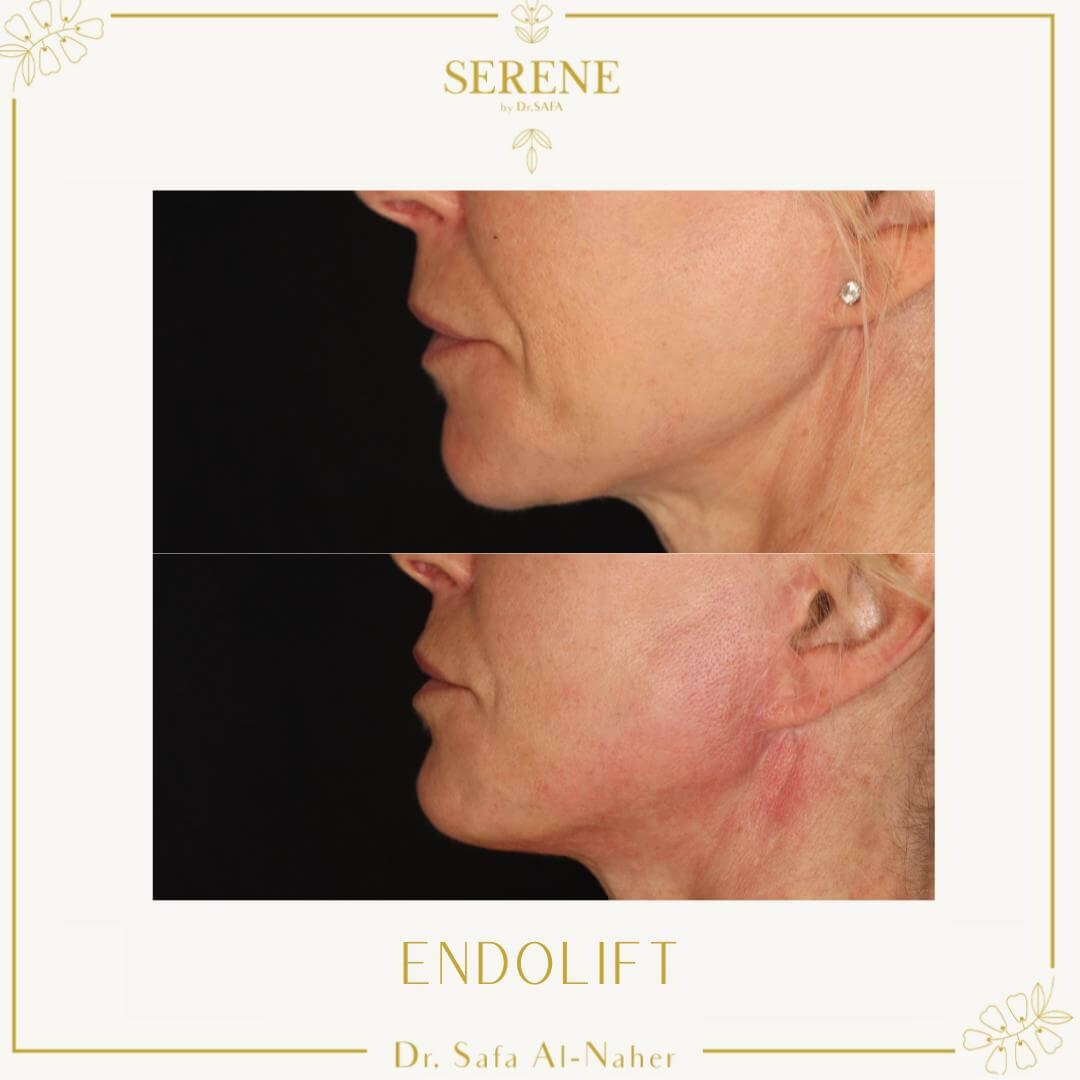 Endolift-london-7