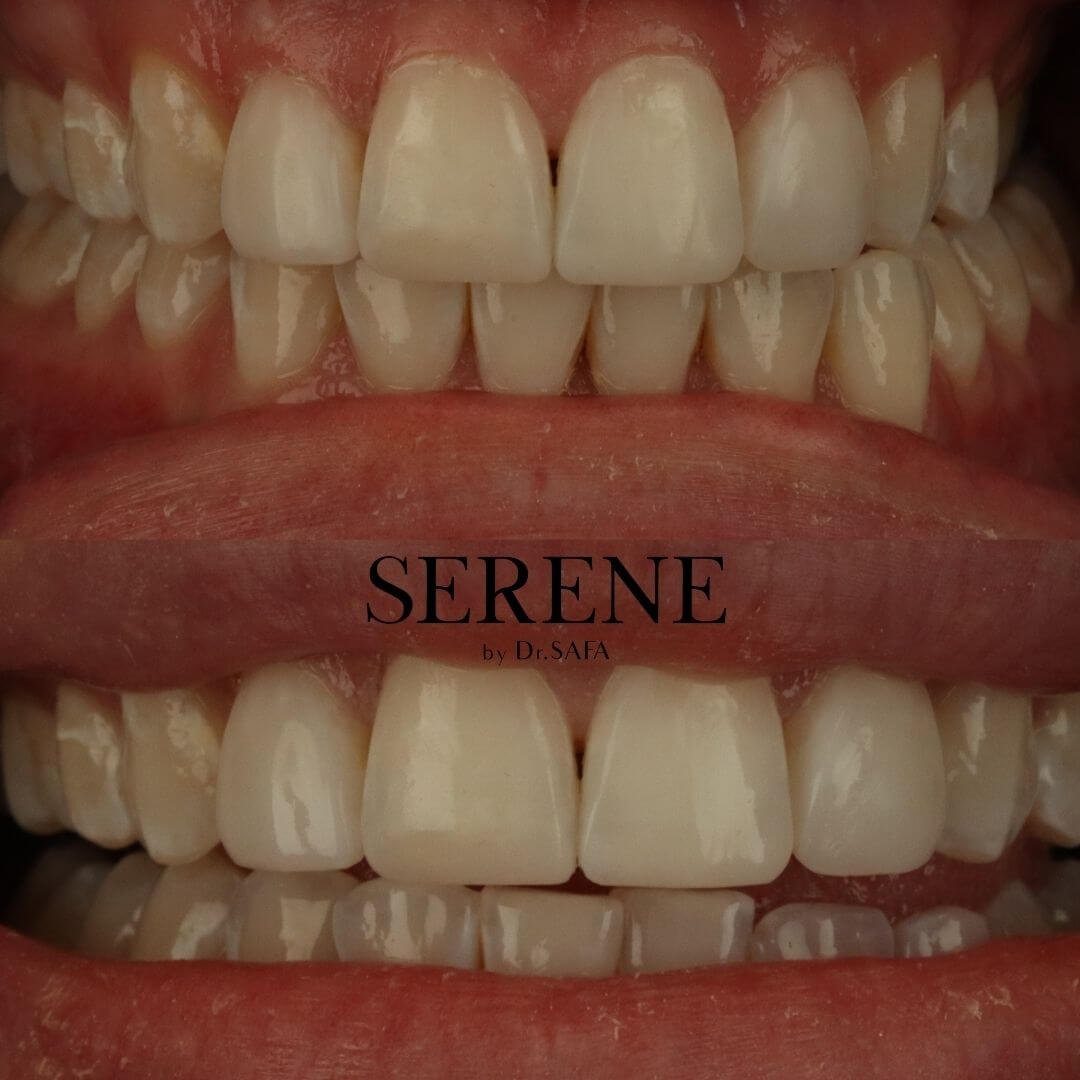 invisalign-knightsbridge-london1