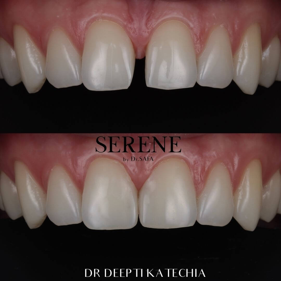 invisalign-knightsbridge-london10