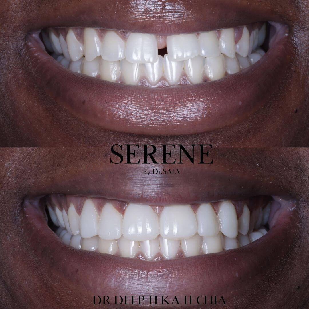 invisalign-knightsbridge-london11