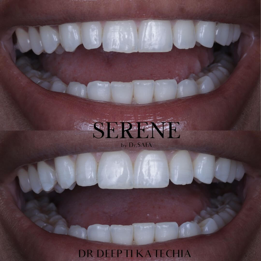 invisalign-knightsbridge-london12