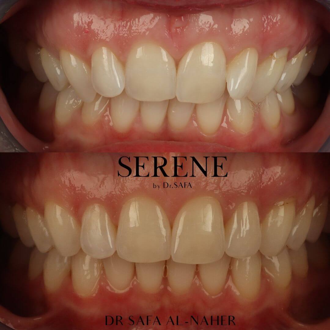 invisalign-knightsbridge-london13