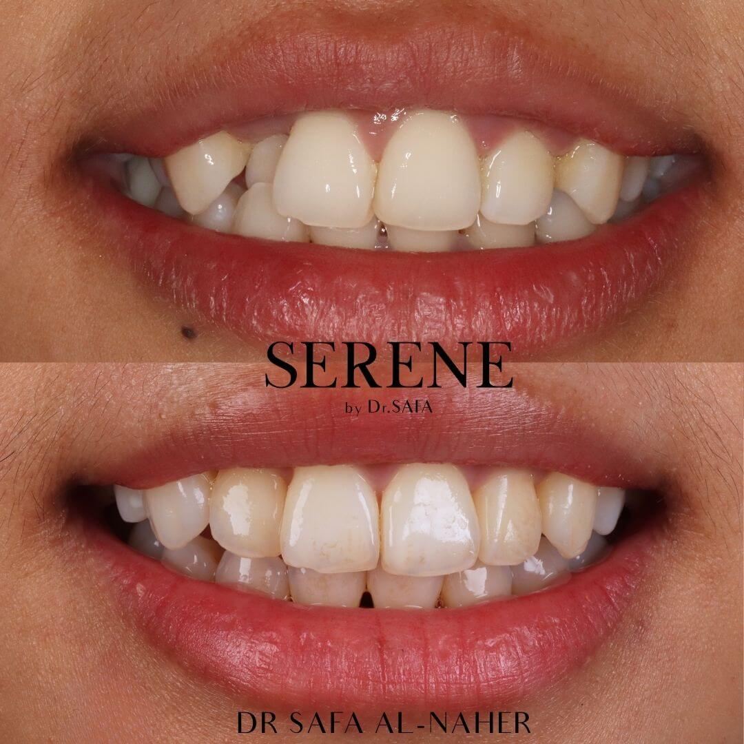 invisalign-knightsbridge-london14