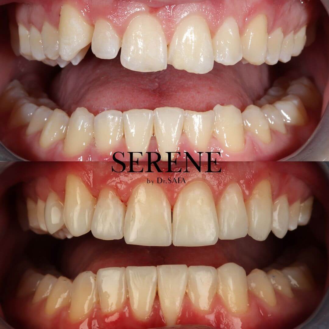 invisalign-knightsbridge-london16