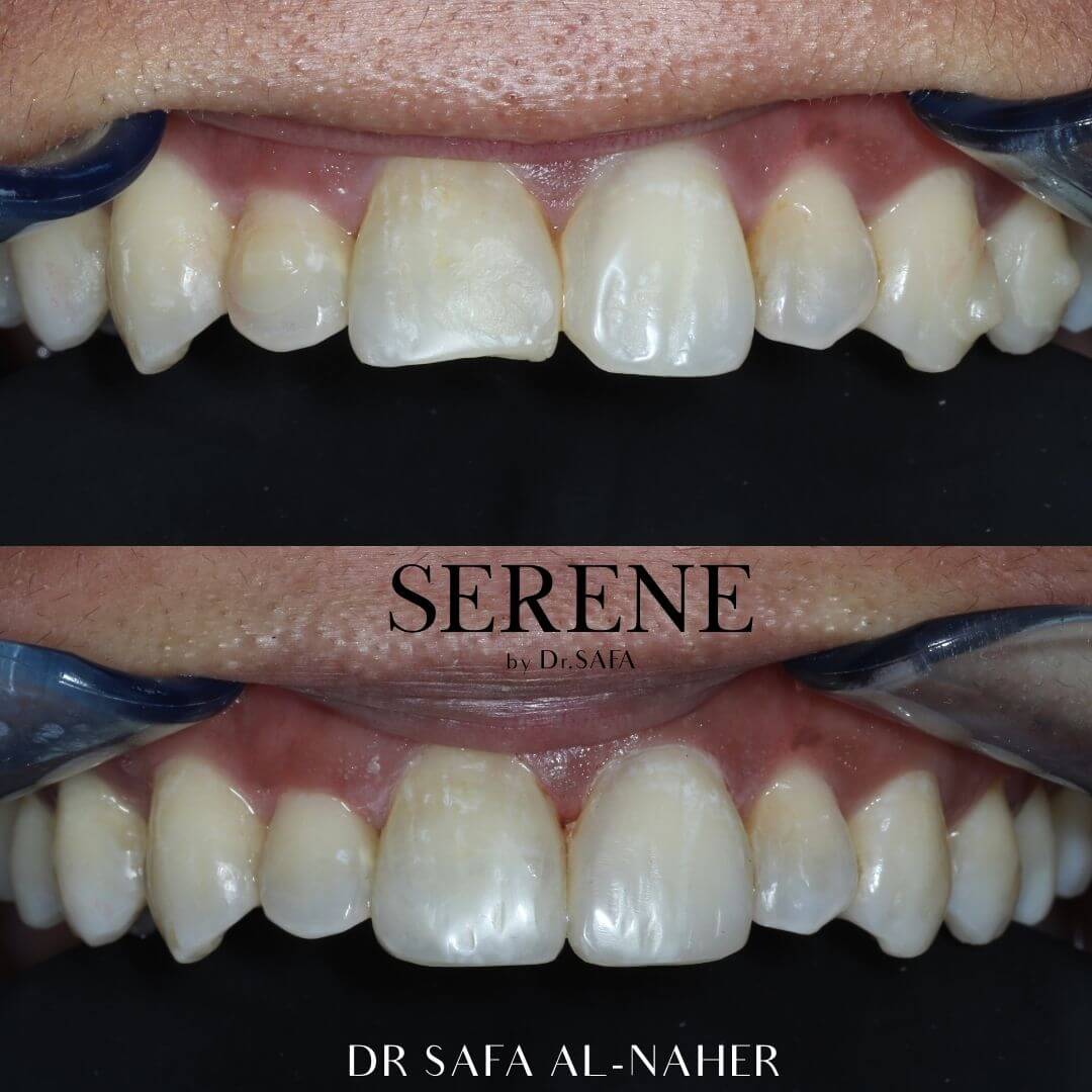 invisalign-knightsbridge-london17