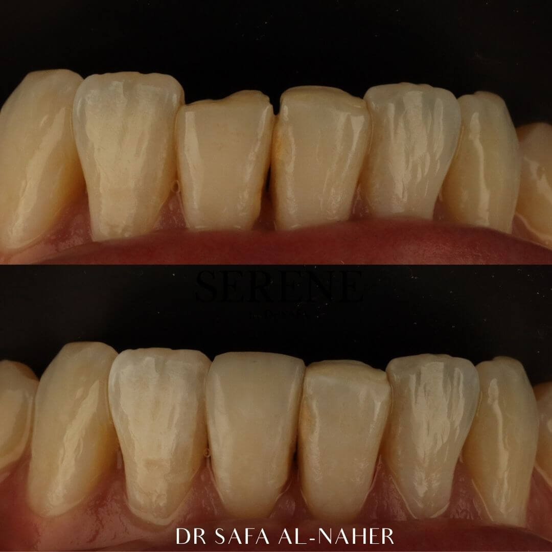 invisalign-knightsbridge-london18