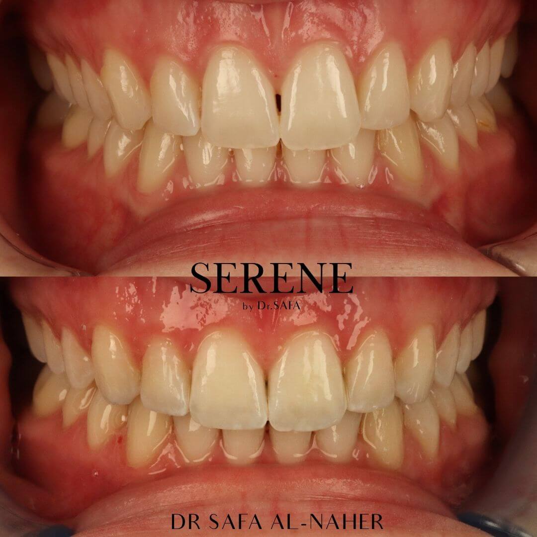 invisalign-knightsbridge-london19