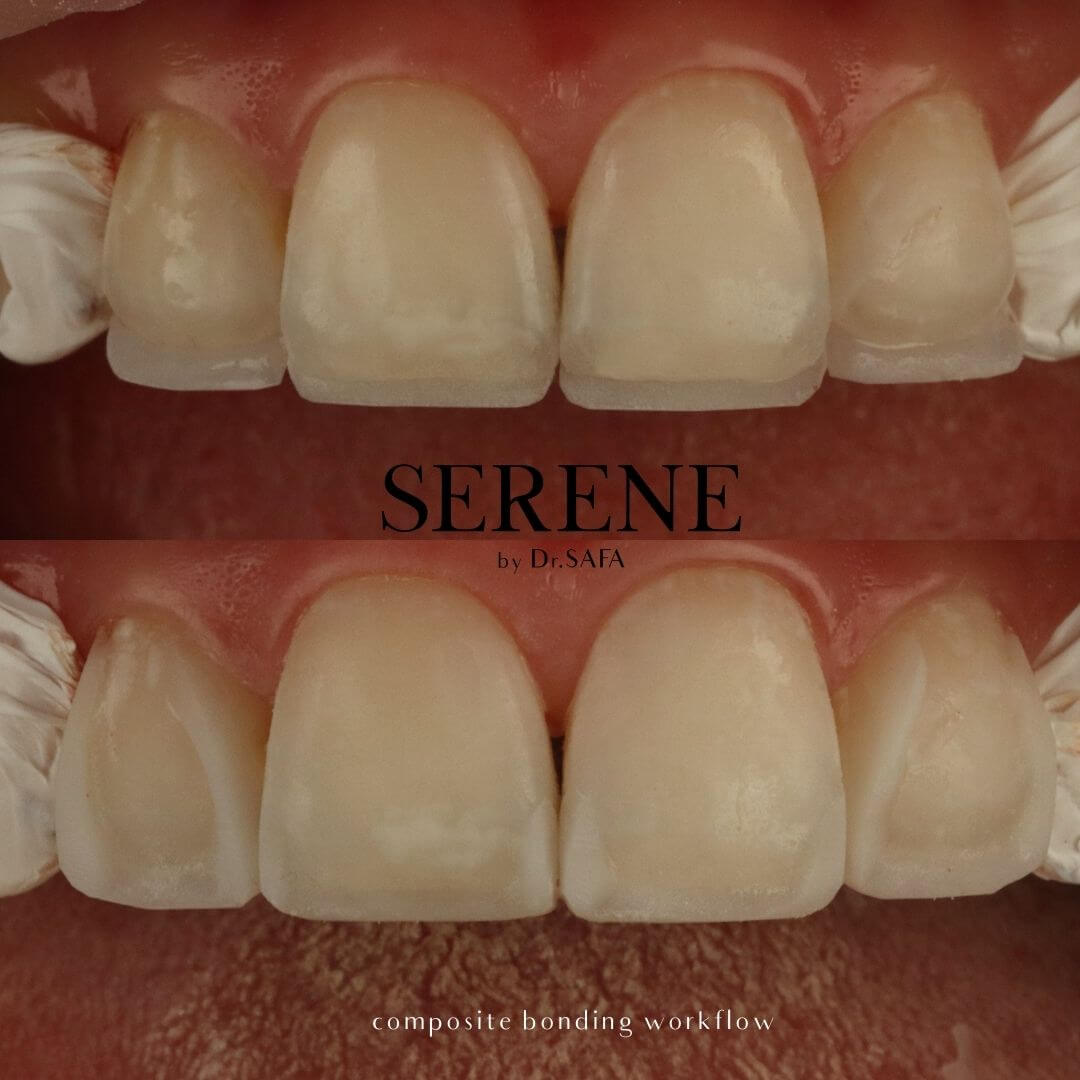 invisalign-knightsbridge-london3
