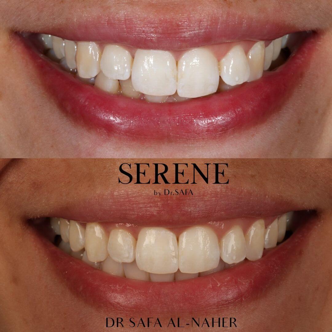 invisalign-knightsbridge-london4