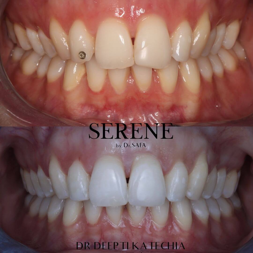 invisalign-knightsbridge-london6