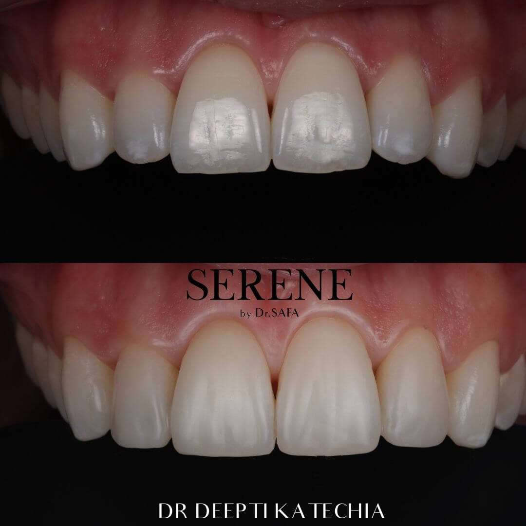 invisalign-knightsbridge-london8