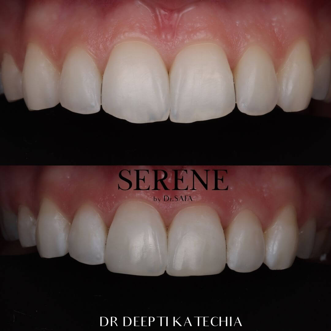 invisalign-knightsbridge-london9